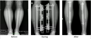 Limb Legthening