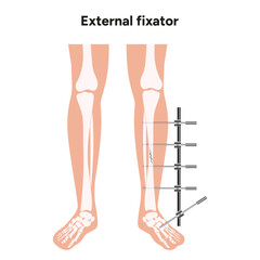 Factors Determining the Lengthening Amount